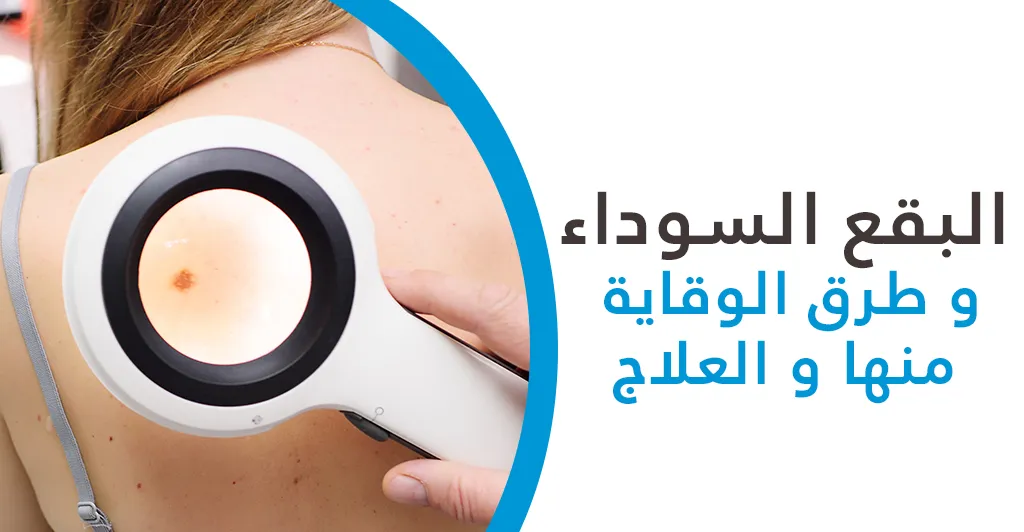 البقع السوداء و طرق الوقاية منها و العلاج